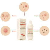 سيروم عشبي لعلاج حب الشباب من سكين دكتور - 10 مل