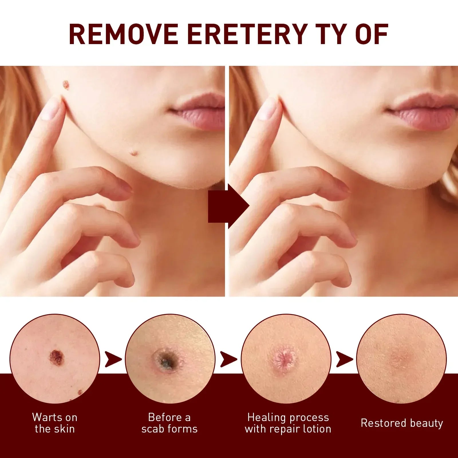 Jaysuing Liquid Warts Flat Eliminate - 3ml Jaysuing Liquid Warts Flat Eliminate - 3ml