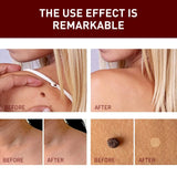 Jaysuing Liquid Warts Flat Eliminate - 3ml