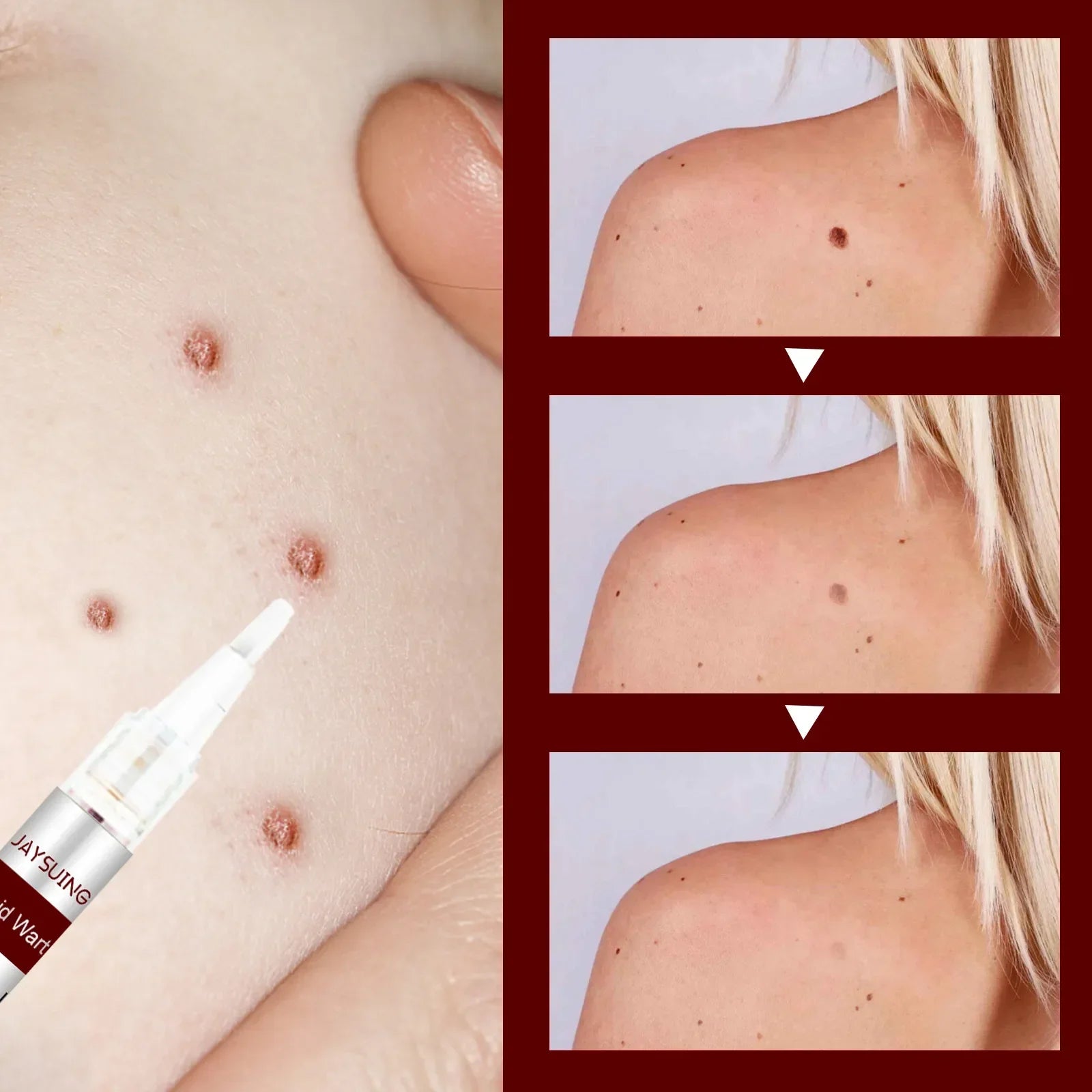 Jaysuing Liquid Warts Flat Eliminate - 3ml Jaysuing Liquid Warts Flat Eliminate - 3ml