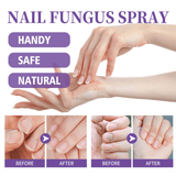 Jaysuing Nail Fungus Spray - 100ml
