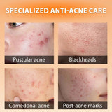 Skinoren Azelaic Acid 20% Anti-Acne Cream - 30g