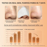 Skinoren Azelaic Acid 20% Anti-Acne Cream - 30g