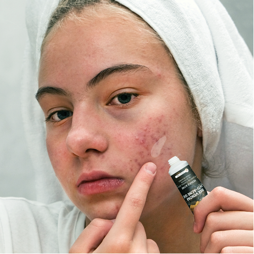 Sumifun Bee Venom Anti-Acne Gel - 20g Sumifun Bee Venom Anti-Acne Gel - 20g