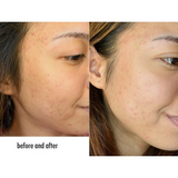 Belo AcnePro Pimple-Fighting Bar 65g