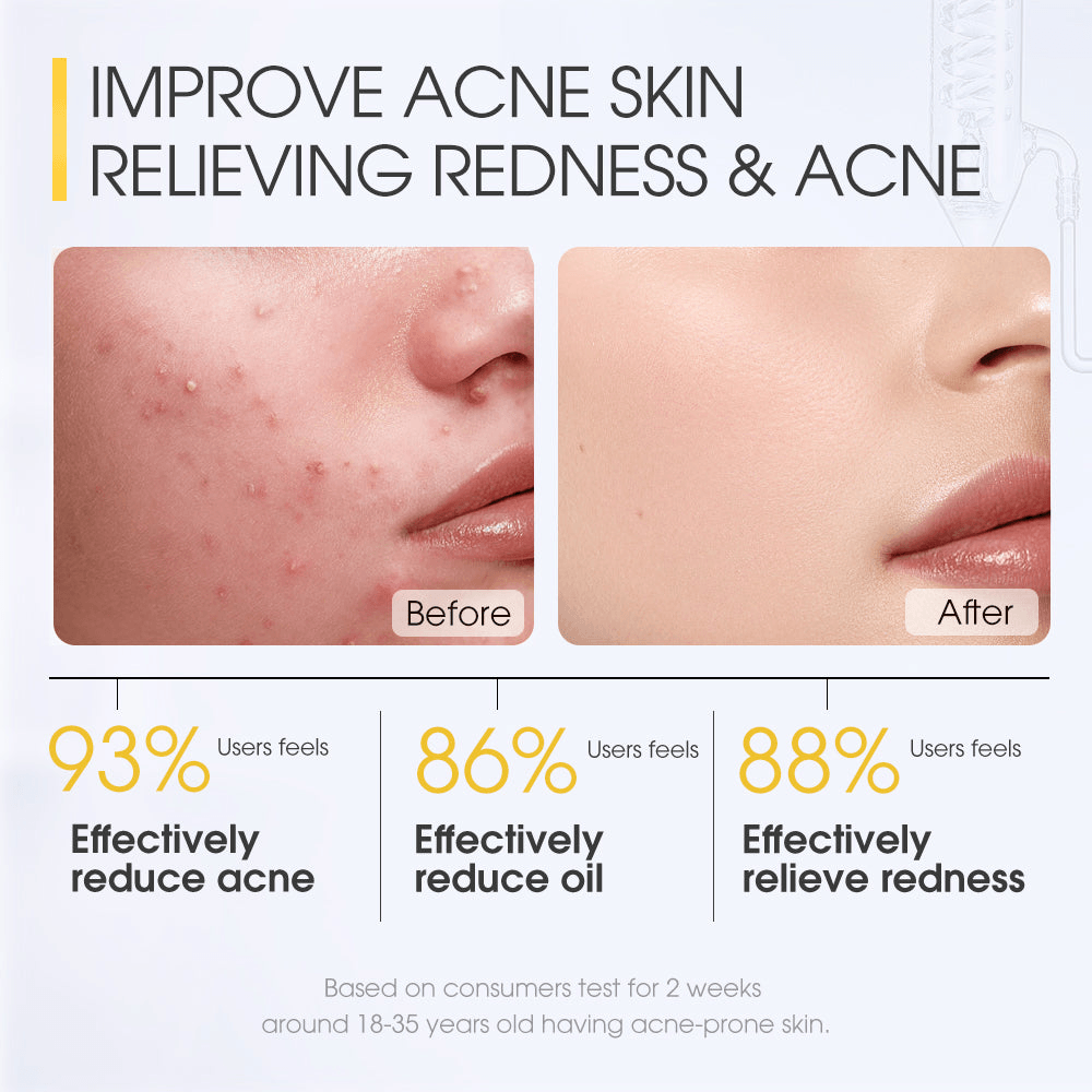 Skinever Salicylic Acid Acne Treatment Ice Sleep Masque - 75ml Skinever Salicylic Acid Acne Treatment Ice Sleep Masque - 75ml