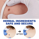 EELHOE Wart Remover Ointment - 20g - Pinoyhyper