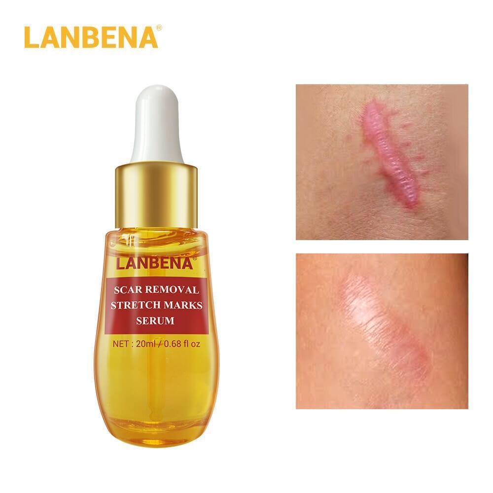 Lanbena Scar and Stretch Mark Removal Serum - 20 ml - Pinoyhyper Lanbena Scar and Stretch Mark Removal Serum - 20 ml - Pinoyhyper