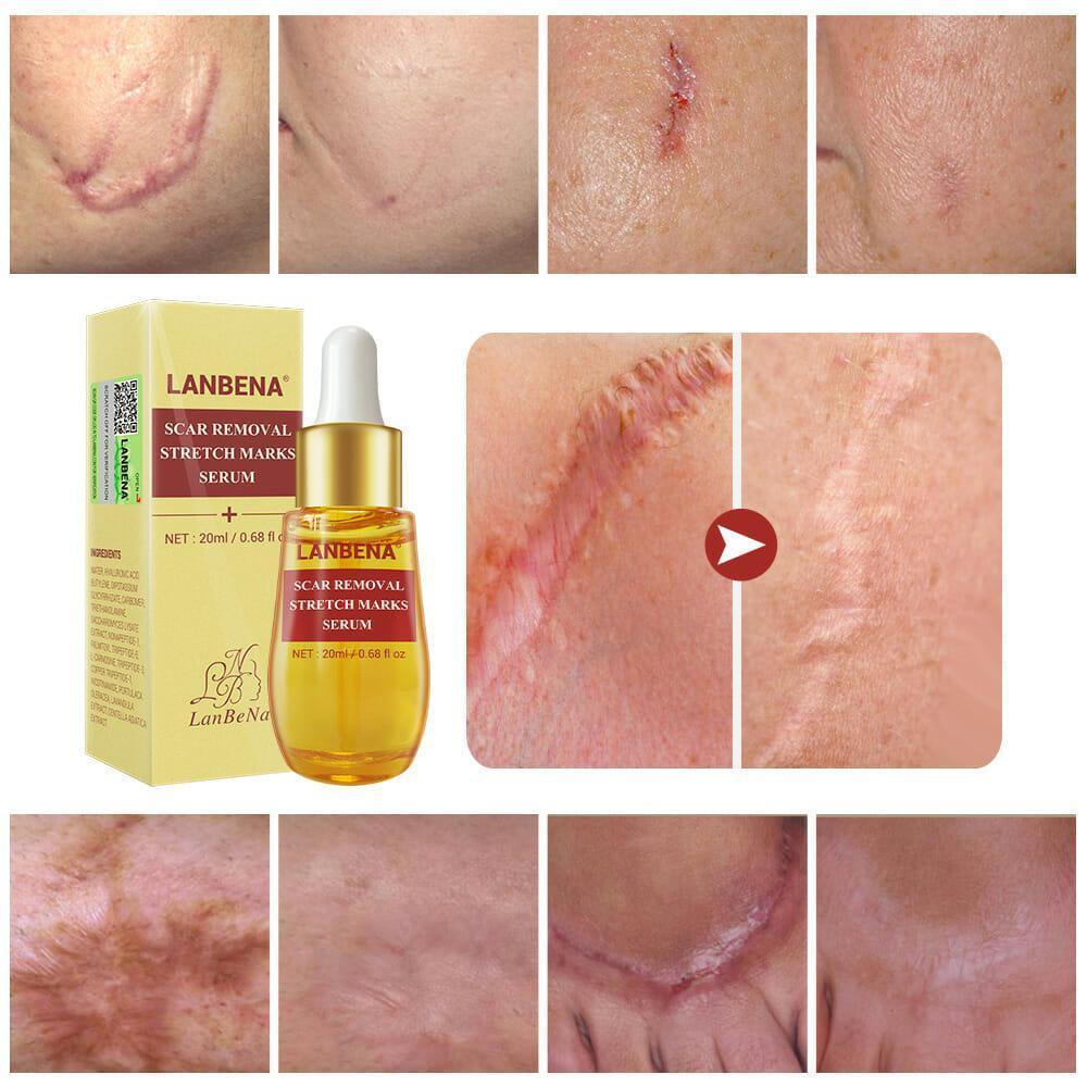 Lanbena Scar and Stretch Mark Removal Serum - 20 ml - Pinoyhyper Lanbena Scar and Stretch Mark Removal Serum - 20 ml - Pinoyhyper