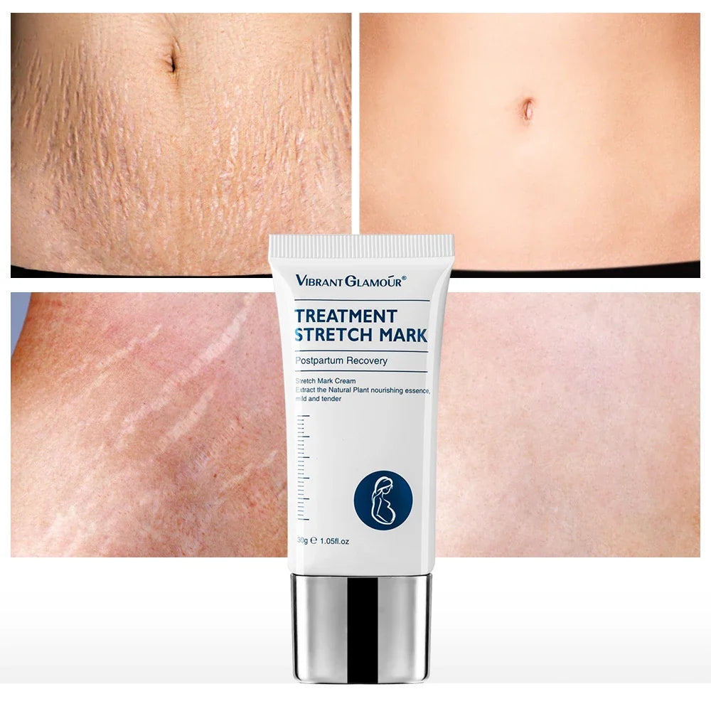 Vibrant Glamour Stretch Marks Remover Cream - 30g