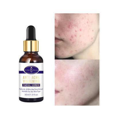 Anti-Acne Whitening Facial Serum 30ml - Aichun Beauty - Pinoyhyper