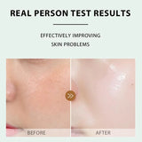 LBLS Salicylic Acid Acne Milk Facial Cleanser - 100g