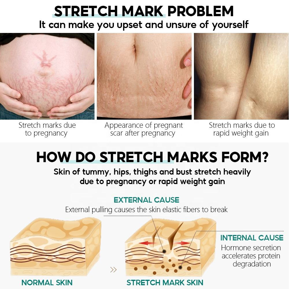 Vibrant Glamour Stretch Marks Remover Cream - 30g