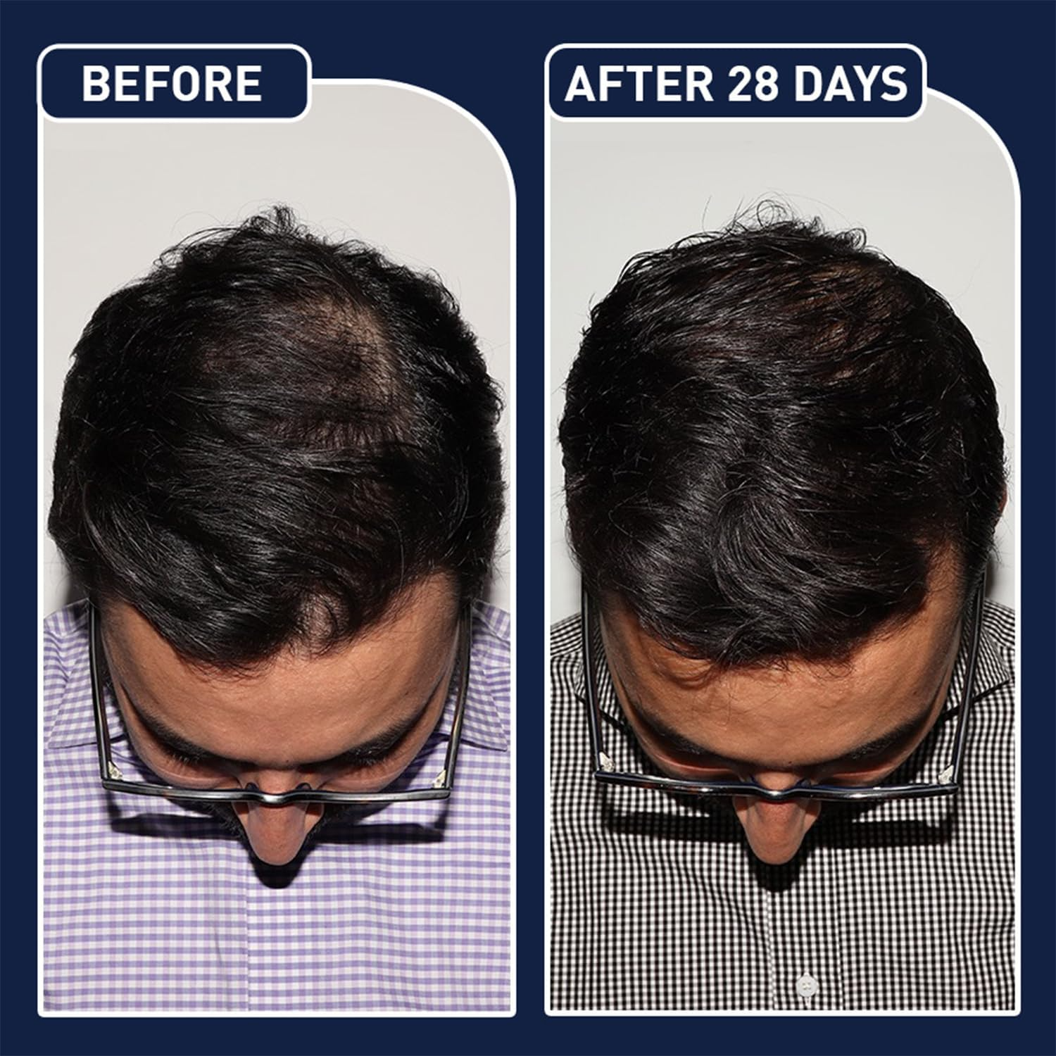 FEG Plus Hair Growth Spray Prevent Hair Loss - 50ml