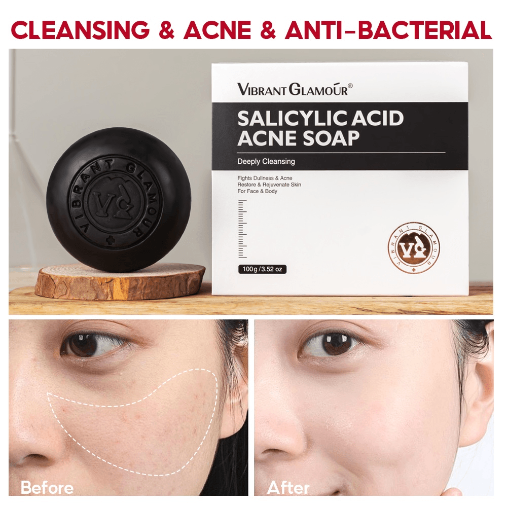 Vibrant Glamour Salicylic Acid Acne Soap - 100g