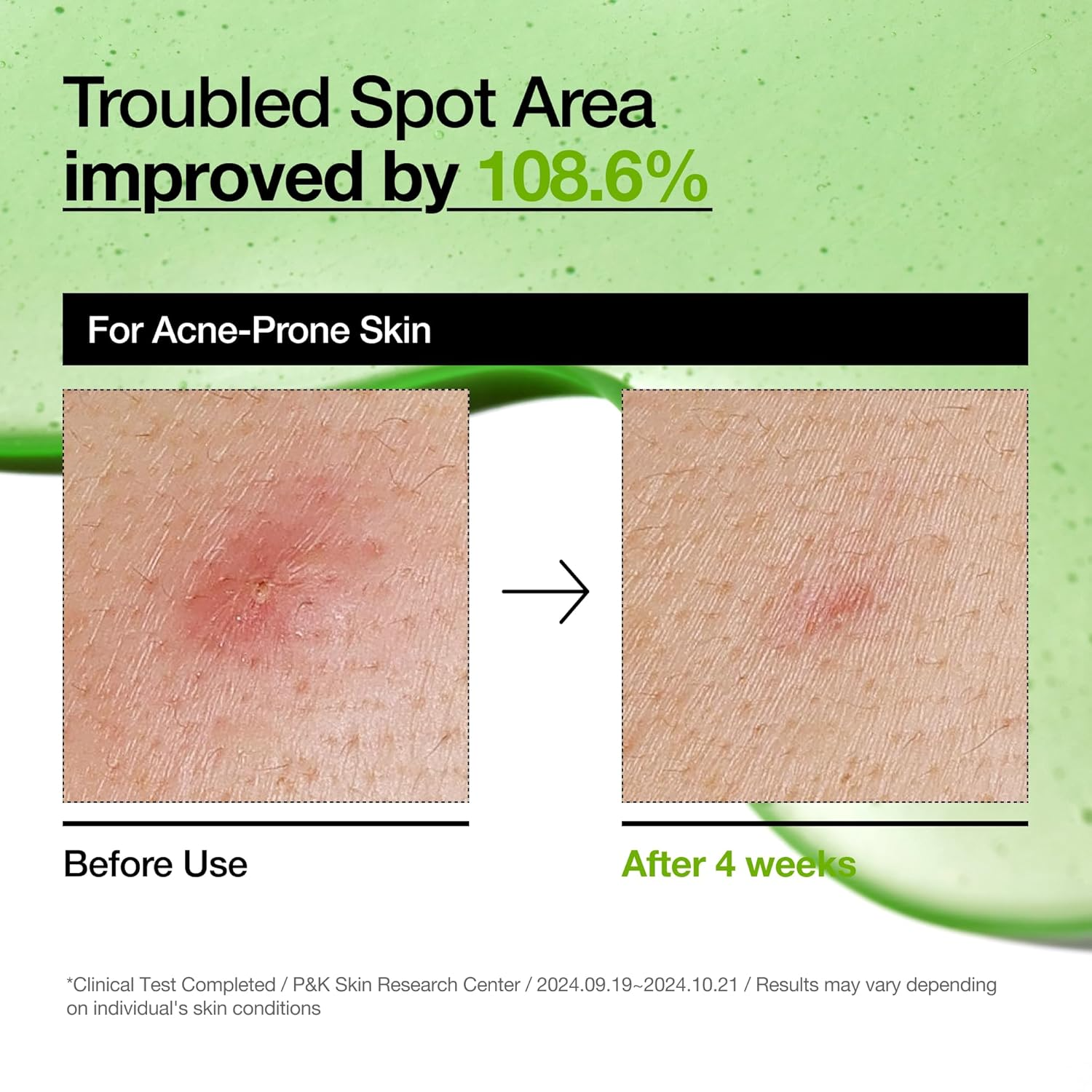 Anua Azelaic Acid 10 Hyaluron Redness Soothing Serum - 30ml