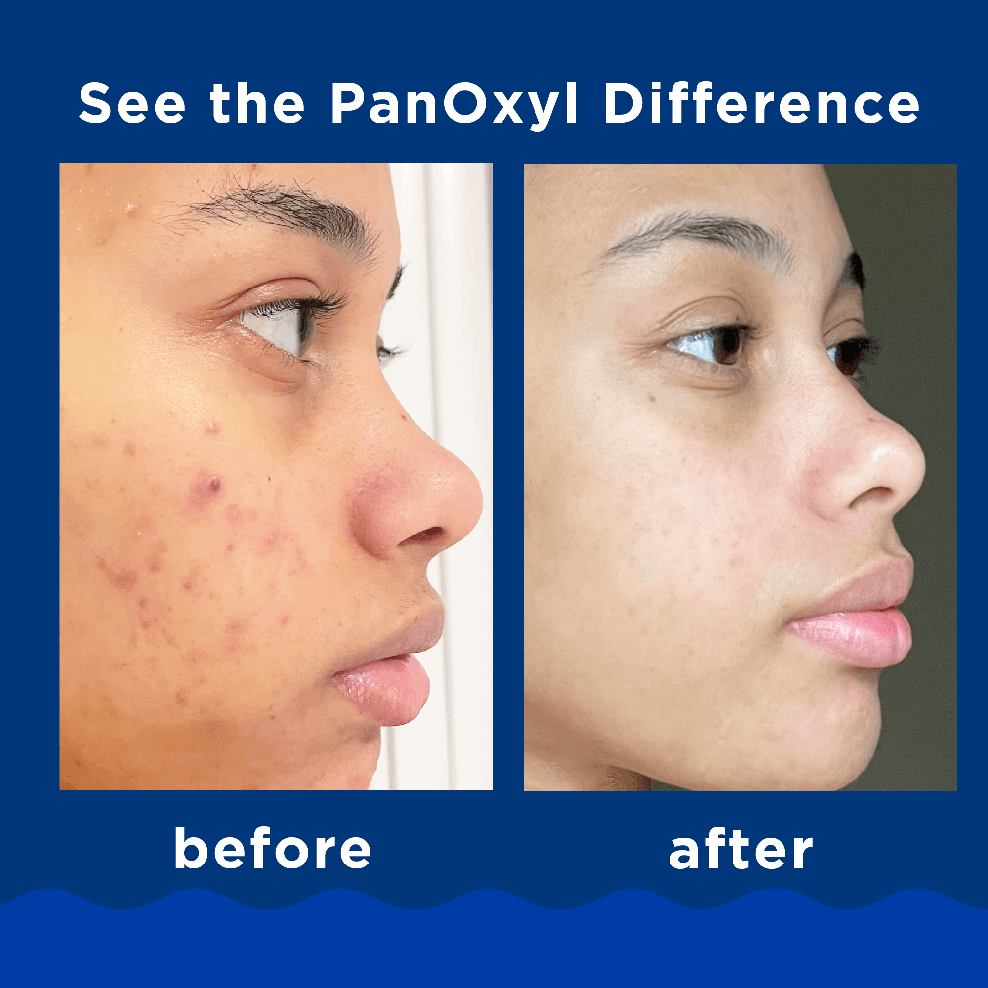 PanOxyl Acne Foaming Wash Benzoyl Peroxide 10% Maximum Strength - 156g