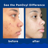 PanOxyl Acne Foaming Wash Benzoyl Peroxide 10% Maximum Strength - 156g