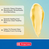 De La Cruz Maximum Strength Acne Treatment - 74g