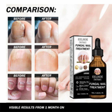 EELHOE Fungal Nail Repair Oil - 50ml