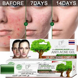 Dr. Davey Dragon's Blood Anti-Acne Gel - 30g - Pinoyhyper