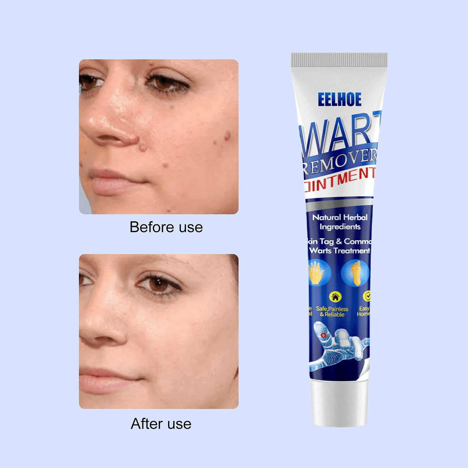 EELHOE Wart Remover Ointment - 20g - Pinoyhyper