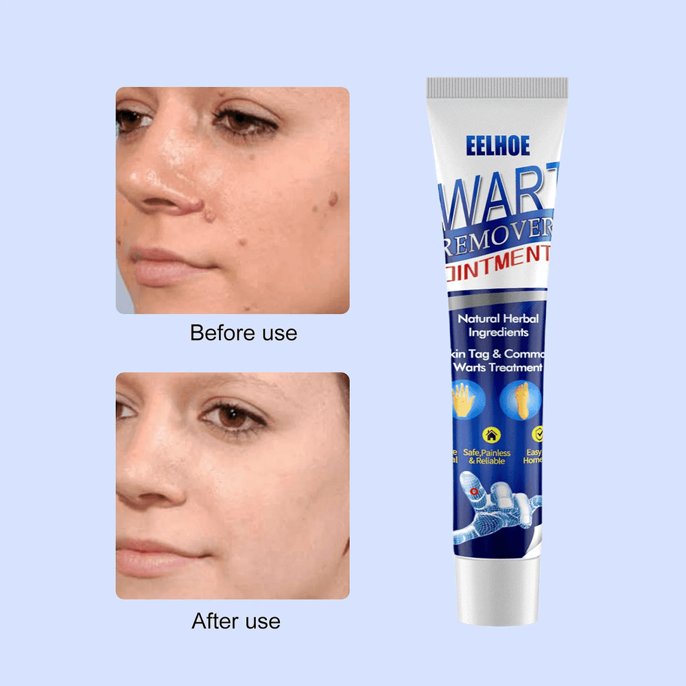 EELHOE Wart Remover Ointment - 20g - Pinoyhyper