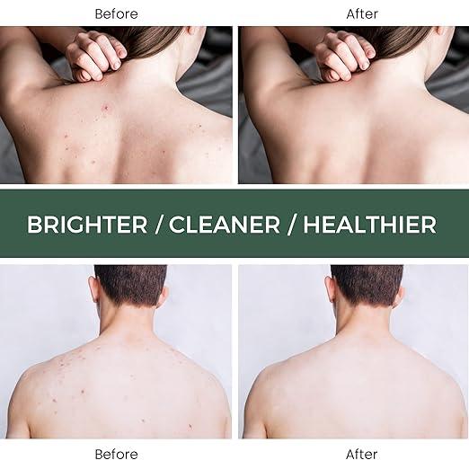 Jaysuing Back Acne Treatment Spray - 120ml - Pinoyhyper